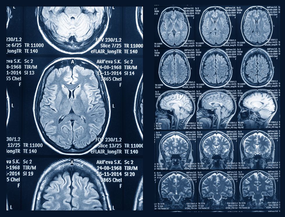 MRI of the brain for diagnosis